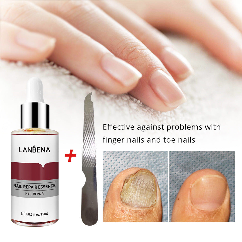 Nagelreparatur mit kleiner Feile 15 ml Anti-Onychomykose Fuß