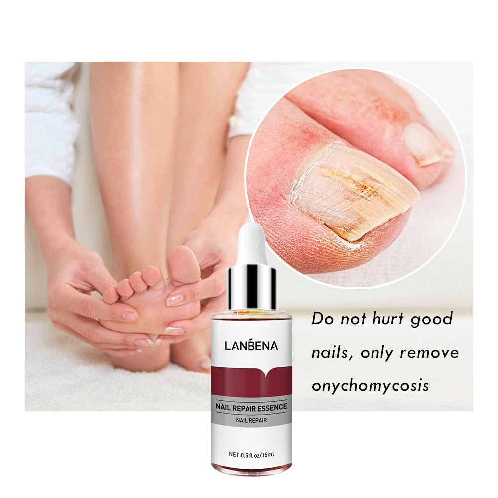 Nagelreparatur mit kleiner Feile 15 ml Anti-Onychomykose Fuß