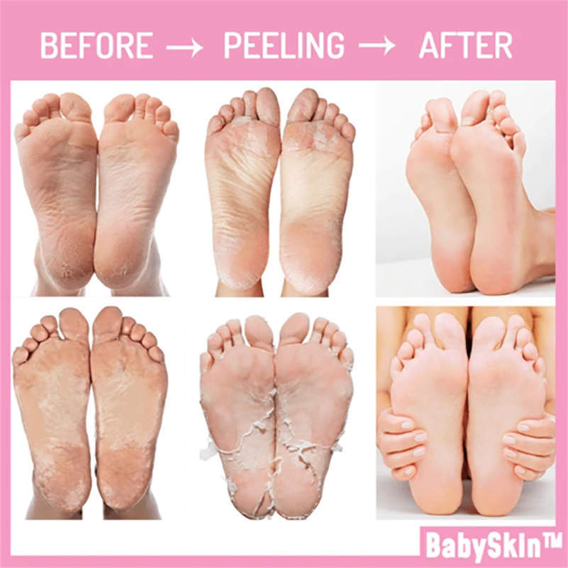 BabySkin Original Peeling-Maske – Originalqualität