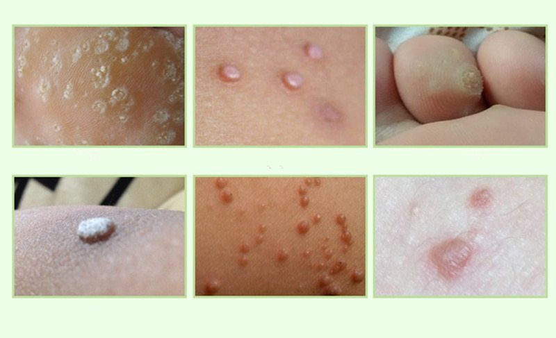 Fuß Entfernung Creme Pflege Medizinische Pflaster Schwielen Plantar Warzen