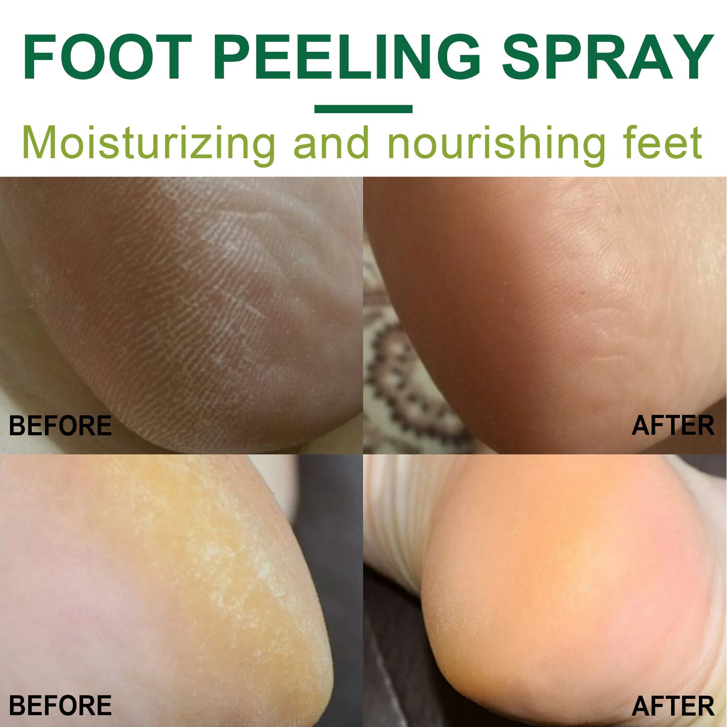 Peeling Füße Entfernen Abgestorbene Haut Und Schwielen Ferse Ellenbogen Und Knie Pflege Spray