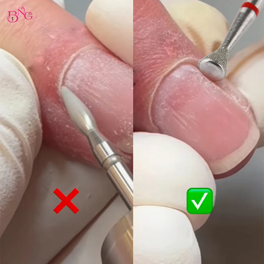 BNG Fräser-Set für Nagelhaut – 5 Stück Sicherheitsfräser für Maniküre
